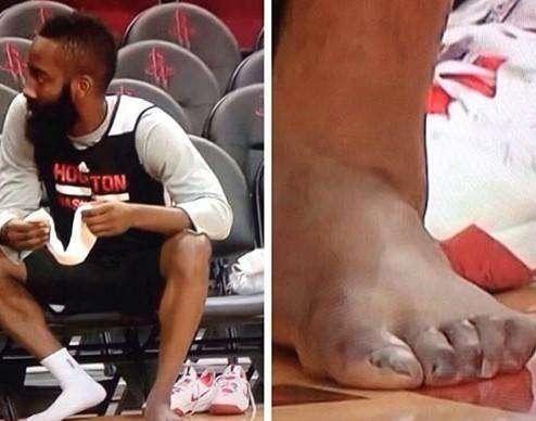nba冠军的脚趾 NBA球员脚趾为何这么多畸形(2)