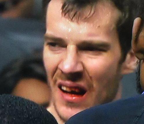 nba球员牙齿被打掉 NBA门牙被打掉六大瞬间(2)