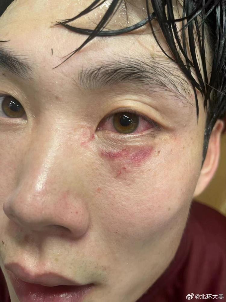 博主晒徐浩峰受伤照片，左侧眼眶和眼球均有淤血(2)